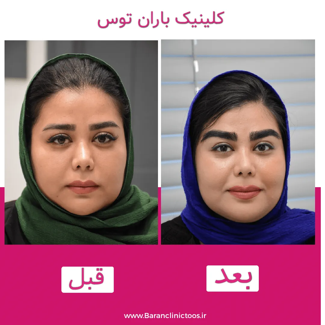 قبل و بعد کاشت ابرو